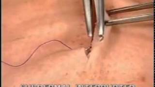 subdermal interrupted suturing [upl. by Peppie]