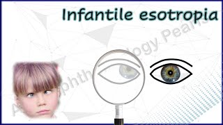 Infantile Esotropia Simplified 1│Understanding Various Phenomena amp Differential Diagnosis [upl. by Haye]