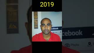 vikram BGM  tamilan hair transplant result before amp after hairtransplant besthairtransplant [upl. by Eleirbag]