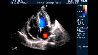 Pericarditis AgudaTaponamiento Cardiaco Dr Pedro Guillermo Bustos 12 Julio 2011 [upl. by Schuyler]