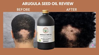 ARUGULA SEED OIL 8 MONTH REVIEW  COULD IT REGROW HAIR ON A BALD SPOT  BEFORE AND AFTER RESULTS [upl. by Mulry]