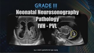 Neonatal Neurosonography  Pathology  IVH  PVL [upl. by Odrawde]