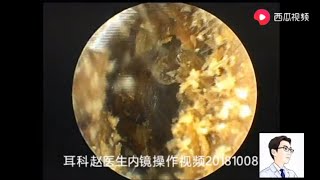 Ear wax removal Bilateral external auditory canal cholesteatoma 8 minutes 双侧外耳道胆脂瘤，8分钟 [upl. by Emmi192]