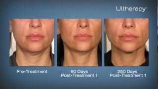 Ultherapy Before amp After Pictures at Laser Clinique in San Diego [upl. by Drol]