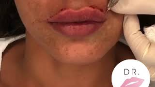 Filler Labbra by Dr Pierluigi Gigliofiorito for Dr Lips [upl. by Oribel573]