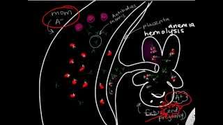 Hemolytic Disease of the Newborn [upl. by Skyla691]