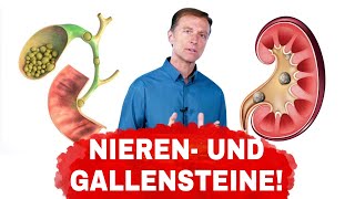 Ursachen von Gallen und Nierensteinen und wie man sie vermeidet  Dr Berg Deutsch [upl. by Ennael]