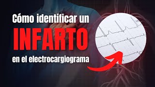 Cómo identificar un infarto agudo de miocardio en el electrocardiograma [upl. by Leizahaj299]