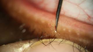 Breaking Meibomian Gland Cyst Cap with Beveled Needle to treat Dry Eye [upl. by Airtened]