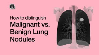 Distinguish Malignant vs Benign Lung Nodules [upl. by Nolly324]