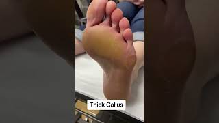 Thick callus removal by a podoatrist [upl. by Nuajed]