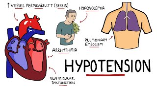 Causes of Hypotension  What causes Low Blood Pressure with Signs and Symptoms [upl. by Yemirej413]