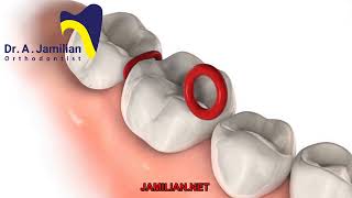 Separating Banding and Bonding in Orthodontics [upl. by Mariken]