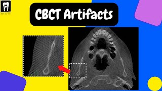 CBCT Artifacts  Basic CBCT CBCT basic understanding  Cone beam computed tomography [upl. by Willin]