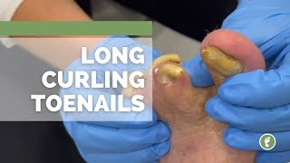 LONG CURLING TOENAILS [upl. by Dahlia]