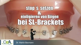 OeA I Bogenwechsel bei SELBSTLIGIERENDEN BRACKETS  Archwire change in selfligating brackets [upl. by Anastasio778]