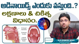 అడినాయిడ్స్ ఎందుకు వస్తుంది  Adenoids or Adenoid Hypertrophy Treatment  Dr Ramesh Babu ENT [upl. by Bodkin]