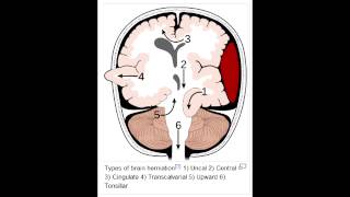 Herniation Syndromes  Cingulate subfalcine Transtentorial Uncal amp Cerebellar Tonsillar [upl. by Charles]