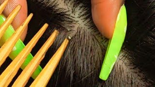 ASMR Rare amp Specific NITPICKING  ATTENTIVE Scalp Inspection triggers 😴 [upl. by Archibaldo719]