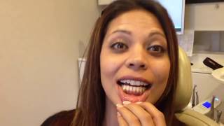 Gingival Pigmentation Removal Dark Gums  Gummy Smile Review [upl. by Charron]