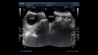 Hepatic Hydatid Cyst [upl. by Diet377]