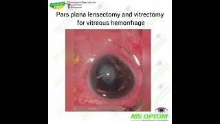 pars plana lensectomy and vitrectomy for vitreous hemorrhage [upl. by Wrdna961]