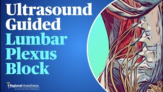 UltrasoundGuided Lumbar Plexus Block [upl. by Oirevas796]