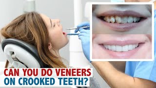 Can you do veneers on crooked teeth [upl. by Sibie]