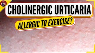 Allergic Reaction To Exercise  Cholinergic Urticaria  Exercise Induced Hives [upl. by Leunad]