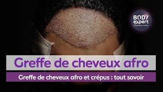 GREFFE DE CHEVEUX TURQUIE  Greffe de cheveux afro et crépus  tout savoir  BODYEXPERT [upl. by Hadrian]