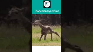 Stoneman Syndrome  FOP  pharmatank5632 shorts viral shortvideo rarediseases [upl. by Tegirb]