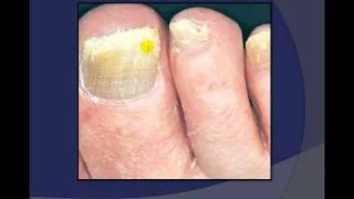 Toenail Debridement by a Podiatrist [upl. by Oileduab695]