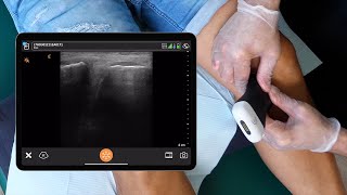 Ultrasound Examination of the Knee [upl. by Yekcor]