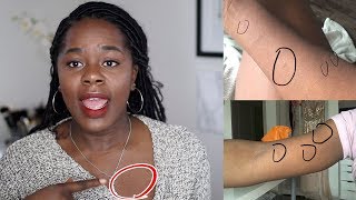 My Skin Story  How I got rid of Pityriasis Rosea  TheAdeTomi [upl. by Asiak]