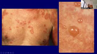 Spongiotic amp Psoriasiform Dermatoses [upl. by Edora]