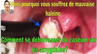 Voici pourquoi vous souffrez de mauvaise haleine Comment se débarrasser du caseum sur les amygdales [upl. by Aiciled813]