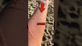 How To Survive a Jellyfish Sting 😨 [upl. by Rehttam]