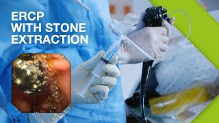 ERCP Practical Guide I Part 2 ERCP with Stone Extraction [upl. by Woermer]