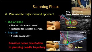 USguided Popliteal Sciatic Nerve Block [upl. by Ailem]