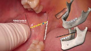 ALVEOLAR INFERIOR NERVE BLOCK  The Best Straightforward Explanation Ever [upl. by Devehcoy]