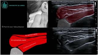 Sonographische Darstellung der kurzen Nackenmuskeln [upl. by Draillih]