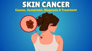 Skin Cancer – Causes Signs and Symptoms Diagnosis amp Treatment [upl. by Alial]