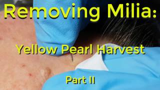 Removing Milia Yellow Pearl Harvest  Part II [upl. by Jenks]