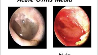 Acute and Chronic Otitis media Cholesteatoma Mastoiditis and Otosclerosis [upl. by Dlaregztif]