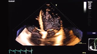 Left ventricular thrombus [upl. by Tova932]