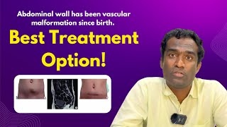 vascular malformation treatment in Hyderabad Dr Shaileshkumar at CitiVascularCentre  malformation [upl. by Annavaj588]