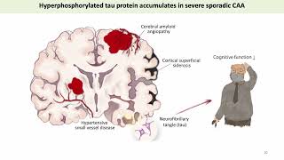 Cerebral Tau Pathology in Cerebral Amyloid Angiopathy [upl. by Iridissa]