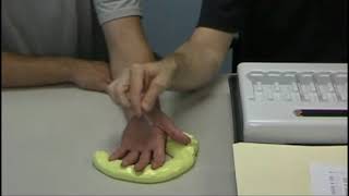 Monofilament Test for Diabetic Neuropathy  Semmes Weinstein Monofilament test [upl. by Ardnikal834]