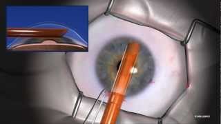 EndoSaver® Corneal Endothelium Delivery Instrument Instructional VideoJune 2012longmp4 [upl. by Malda]