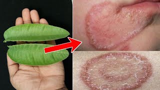 दाद खाज खुजली कितना भी साल पुराना हो 3 दिन में छुट्टी कर देगा  fungal infection on skin treatment [upl. by Fayre]